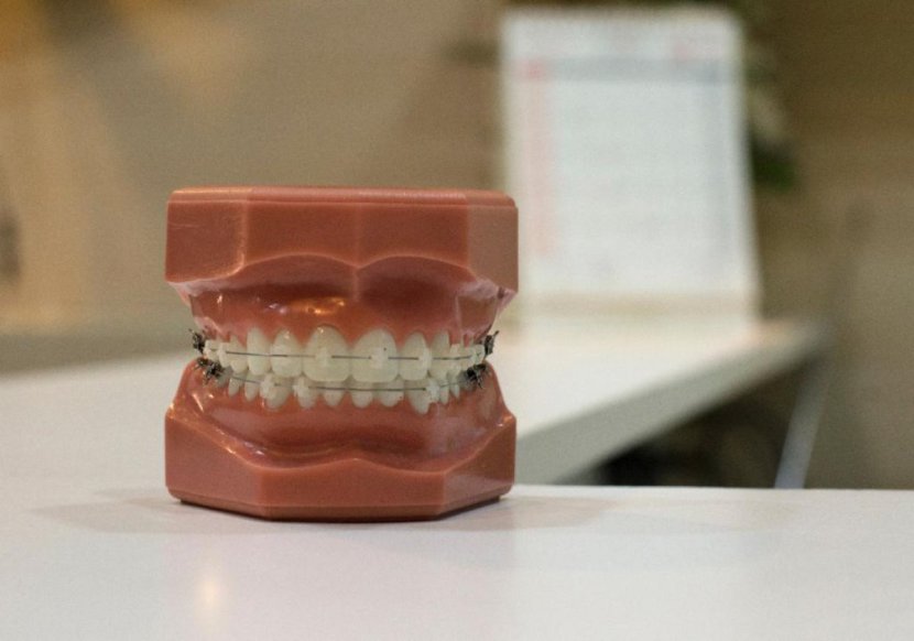 Choice of orthodontic braces