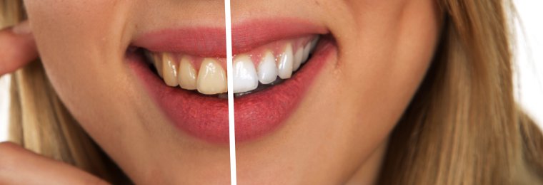 Effects of tooth whitening